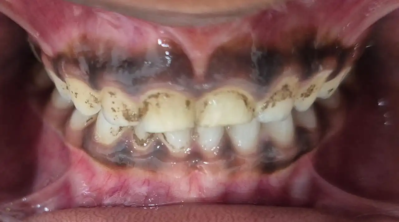 Before smile makeover with porcelain veneers at Smile Story Dental Clinic, Madurai