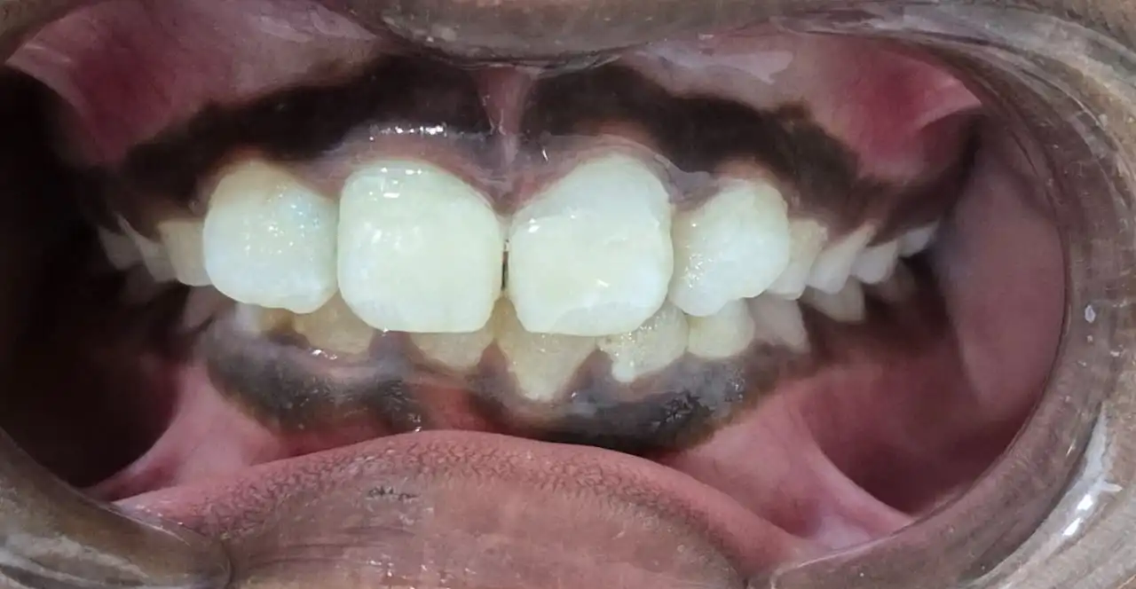 After orthodontic teeth alignment correction at Smile Story Dental Clinic, Madurai