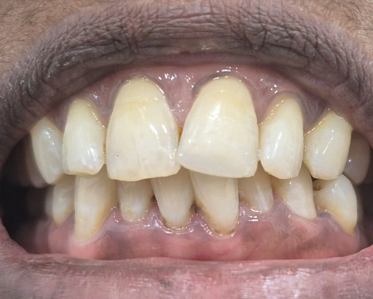 After full mouth rehabilitation with dental implants at Smile Story Dental Clinic, Madurai