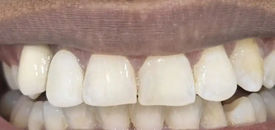 After gum contouring and crown lengthening at Smile Story Dental Clinic, Madurai
