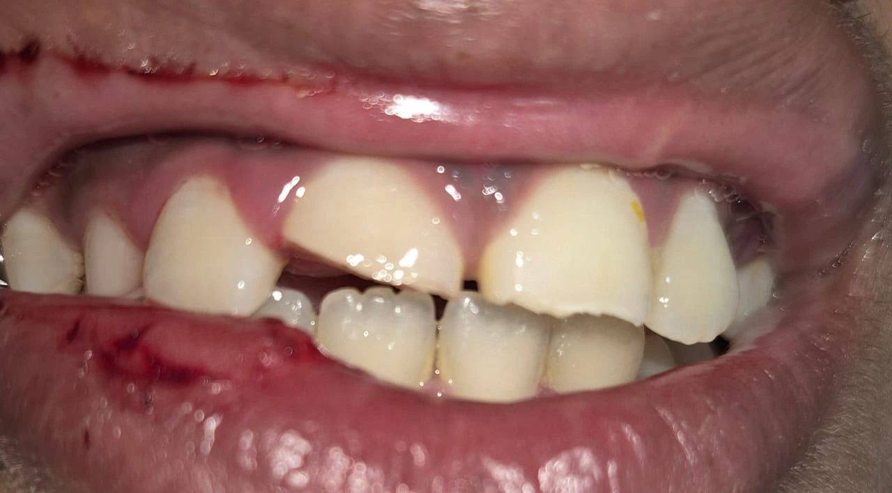Before photo of professional teeth whitening — Smile Story Dental Clinic, Madurai