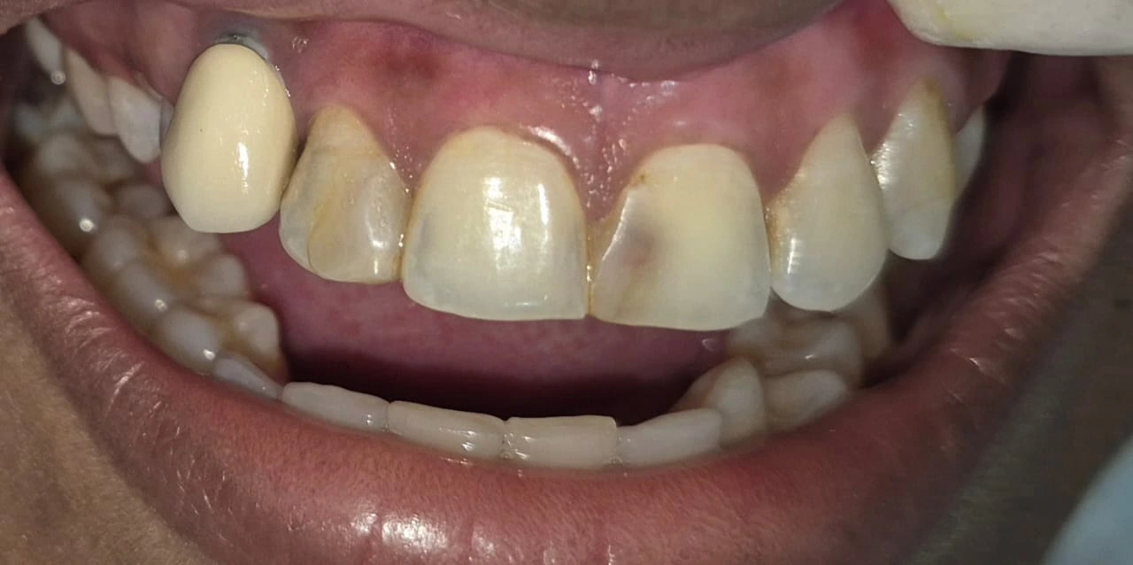 Before photo of gum contouring and crown lengthening — Smile Story Dental Clinic, Madurai