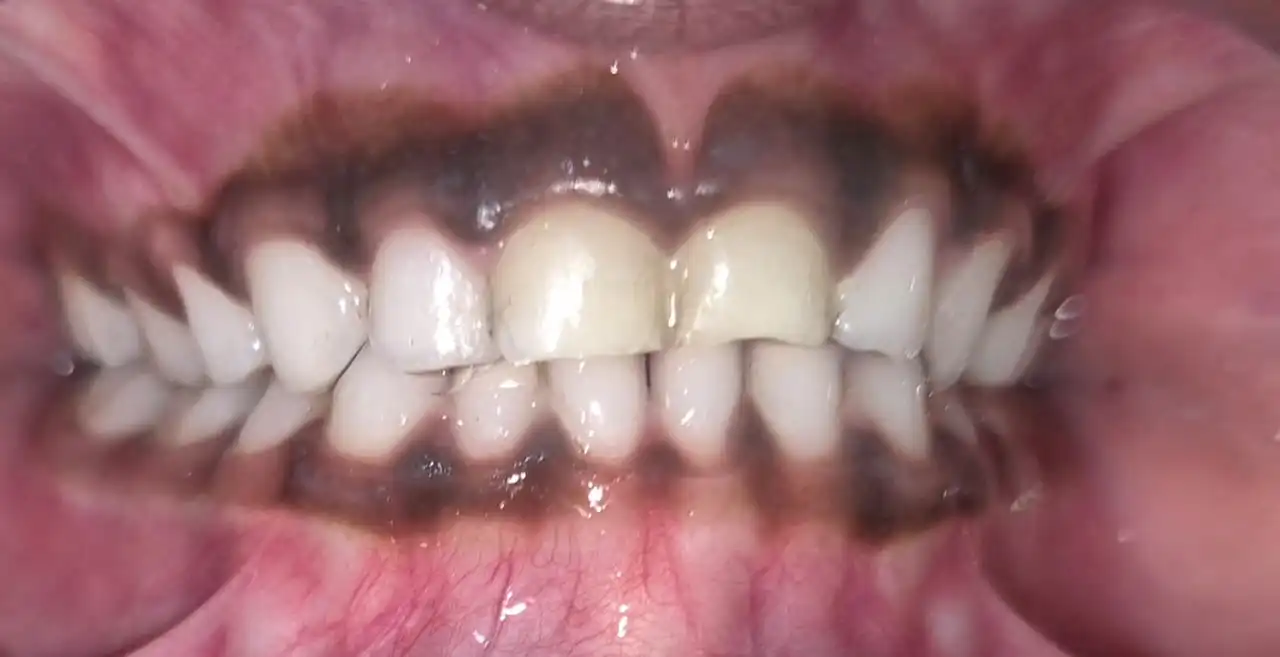 After smile makeover with porcelain veneers at Smile Story Dental Clinic, Madurai