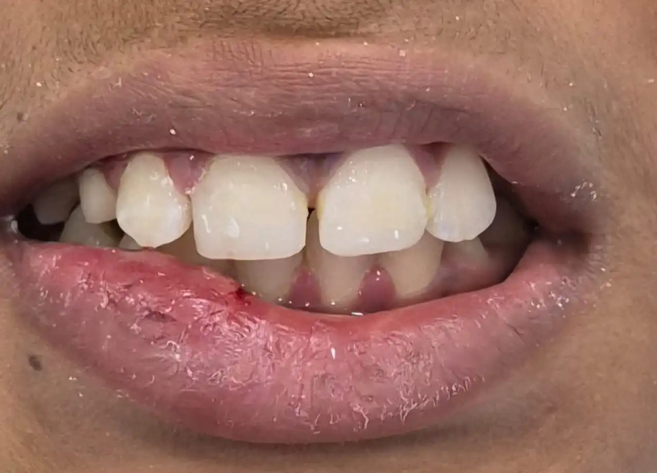 After professional teeth whitening at Smile Story Dental Clinic, Madurai