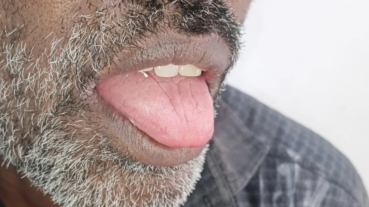 After laser removal of tongue lesion at Smile Story Dental Clinic, Madurai