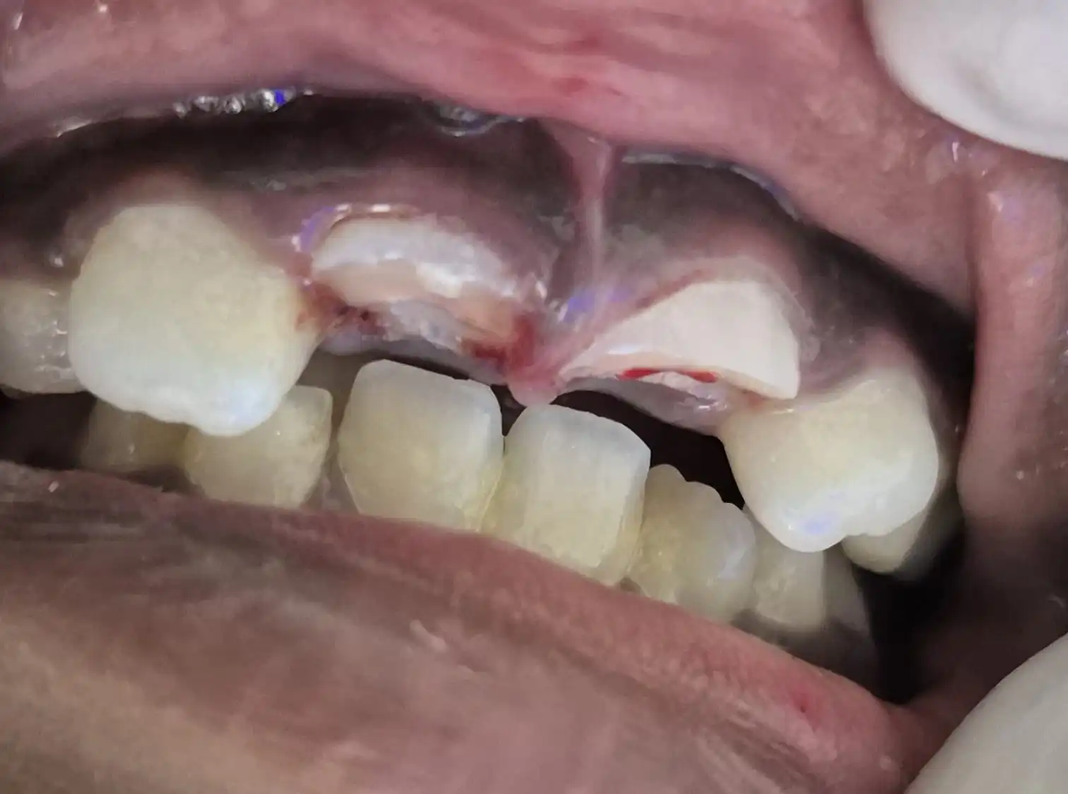 Before photo of orthodontic teeth alignment correction — Smile Story Dental Clinic, Madurai