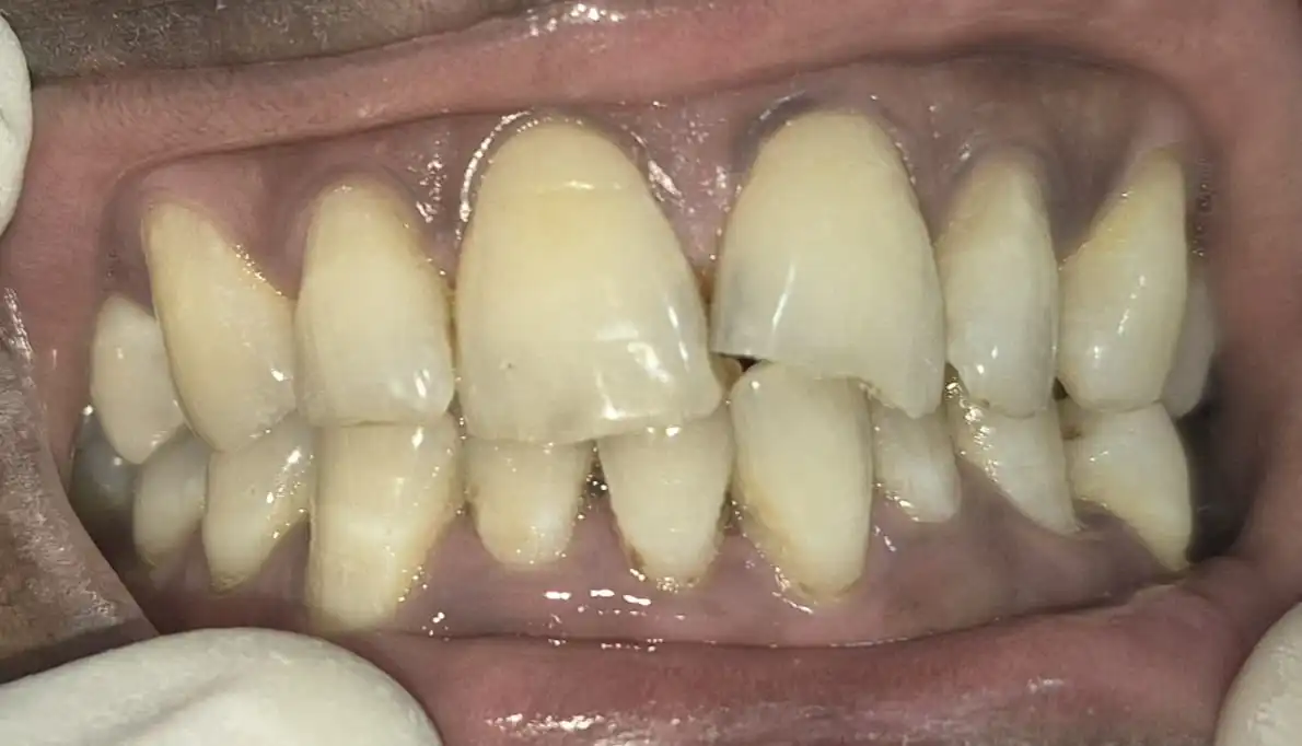 Before photo of full mouth rehabilitation with dental implants — Smile Story Dental Clinic, Madurai