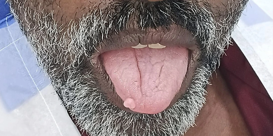 Before photo of laser removal of tongue lesion — Smile Story Dental Clinic, Madurai